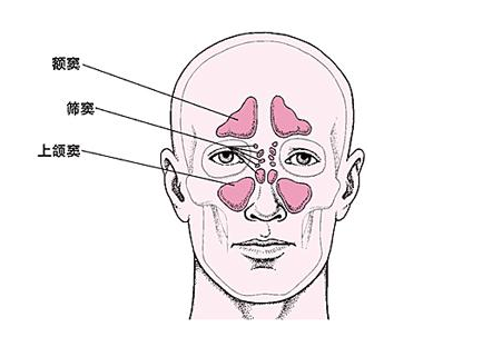 鼻窦炎是鼻窦炎粘膜化脓性炎症,鼻窦炎分为上颌窦,筛窦,额窦,和蝶窦.