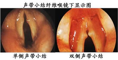 声带小结的预防措施有哪些